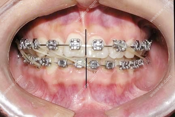 牙齿中线不齐调整后的效果图