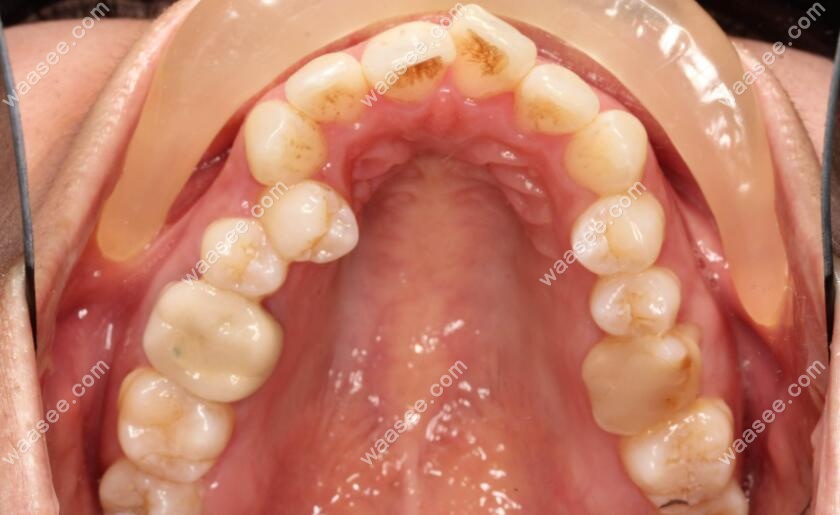 重度牙齿拥挤矫正前的牙齿状况