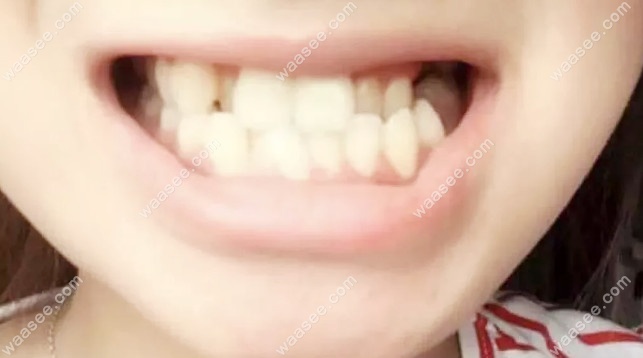 矫正前的牙齿情况