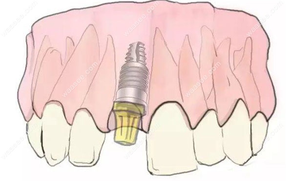 太原众牙口腔种植牙案例