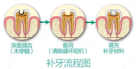 补牙材料选日本可乐丽菲露和3m树脂哪个好?价格区别大吗?