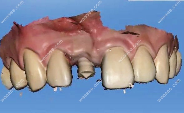 种植牙的电脑3D模拟图