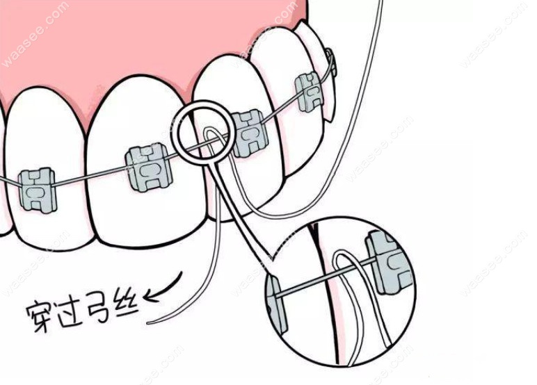 牙齿矫正期间弓丝的更换顺序及粗细等级