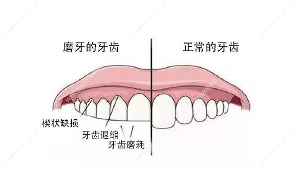 磨牙的牙齿和正常牙齿对比
