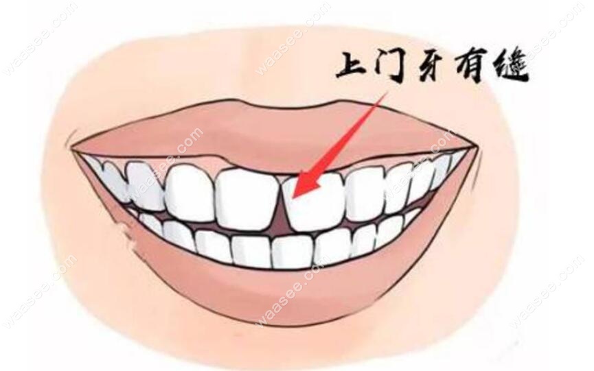 为什么不建议树脂补门牙缝?是因为树脂补牙缝很容易掉吗？