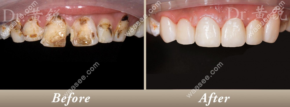 牙齿贴面修复门牙缝隙的案例