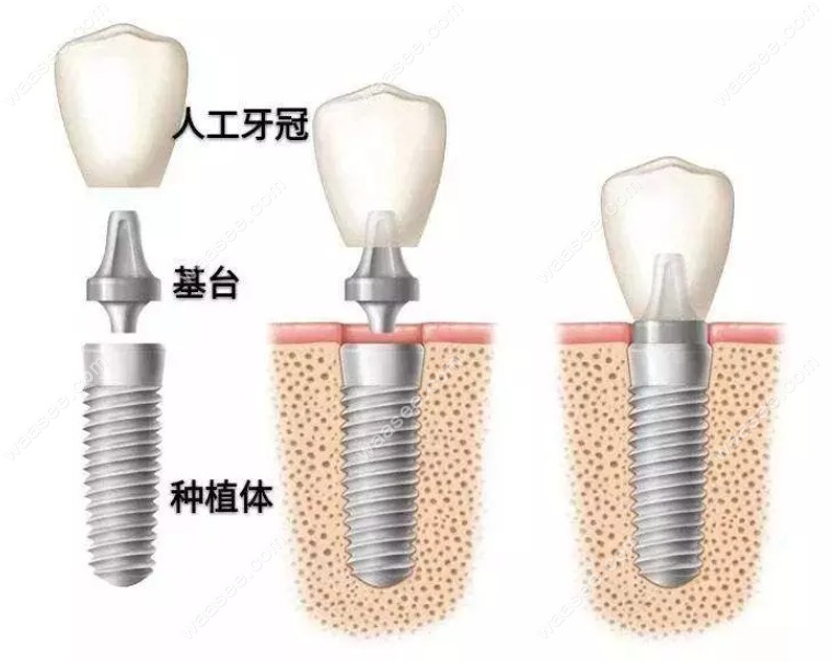 种植牙一期二期三期流程图解，附种牙的基本步骤