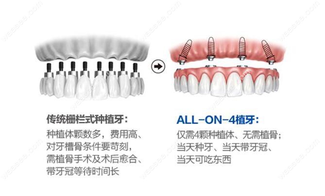 All-on-4种植牙技术优点