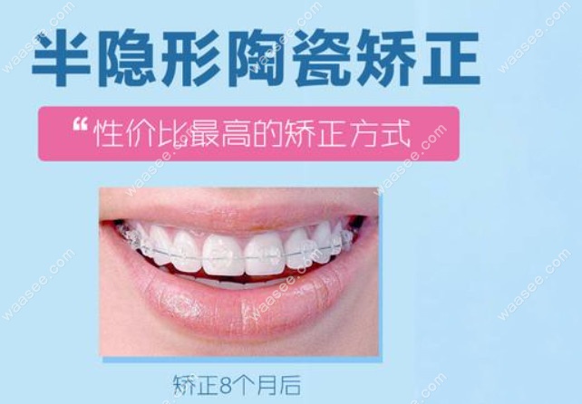 陶瓷半隐形矫正