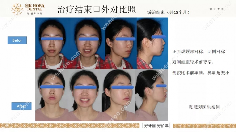 牙齿矫正对比照