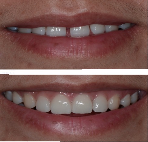 杭州雅乐口腔牙齿修复案例来了，补牙、贴面、全瓷牙都有