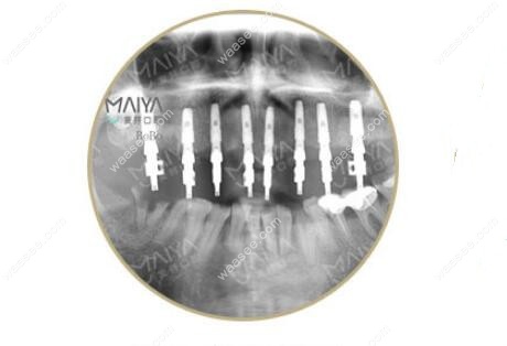 术后CT显示上颌已经成功植入8个种植体