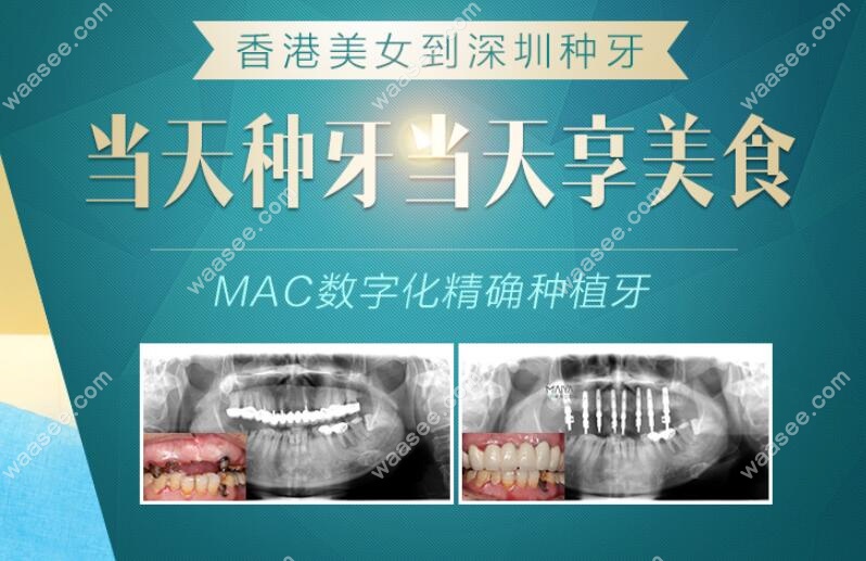 香港美女在深圳麦芽齿科做上半口种植牙真人案例