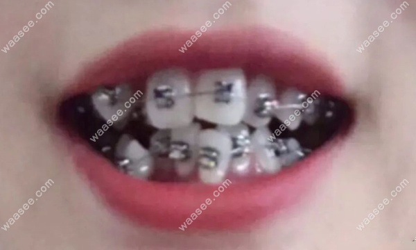 矫正前的牙齿照