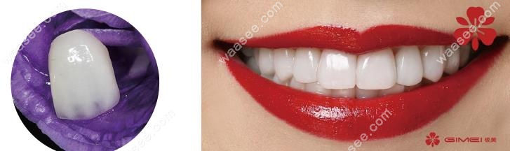 牙齿瓷贴面品牌中的极美贴面是国产的吗?价格贵不贵呢？