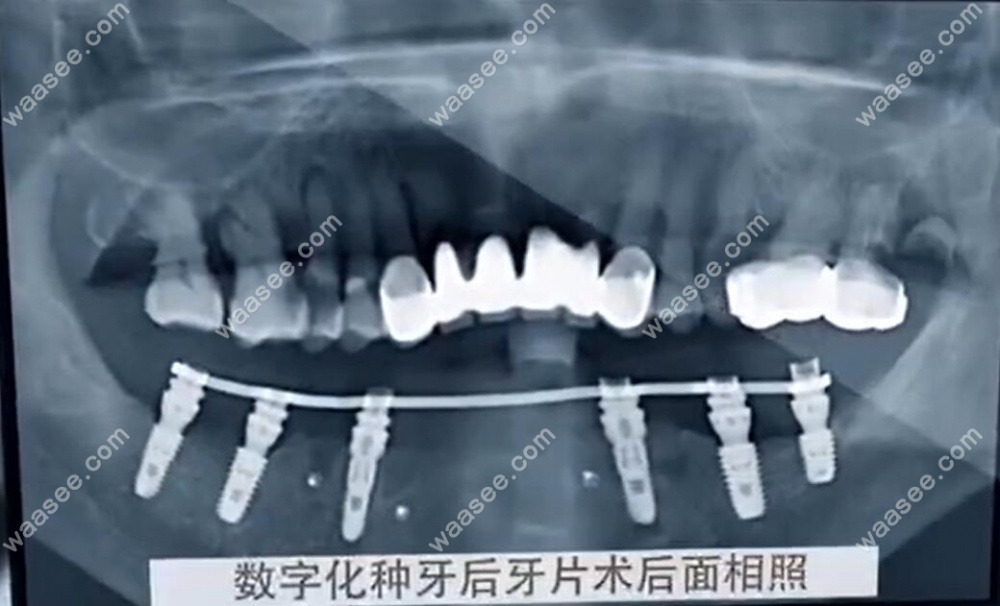 刚做完allon6种植牙拍的CT片