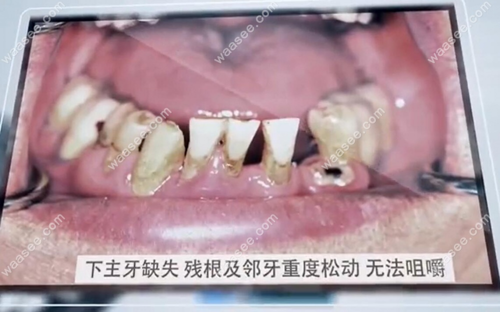 种植牙前下半口口腔状况
