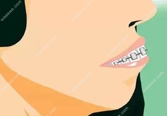 牙性嘴突戴牙套的示意图