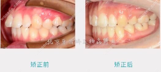龅牙矫正后前后牙齿变化对比
