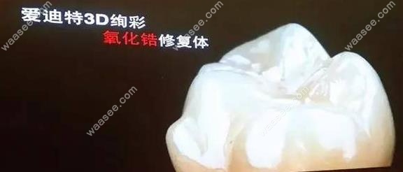 国产爱迪特修复体外观