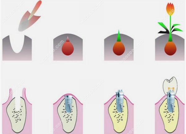 牙齿种植过程示意图