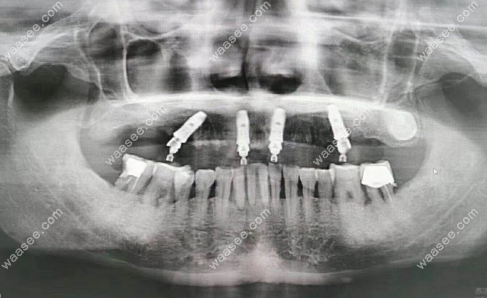 全口种植牙后拍的CT