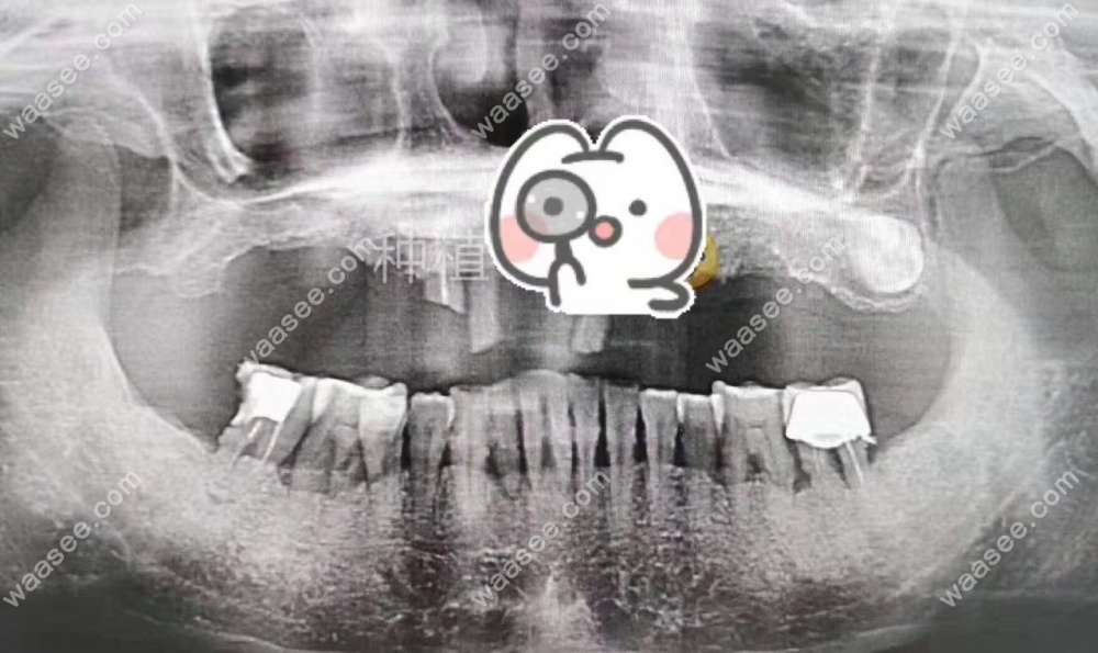 我种牙前拍的CT