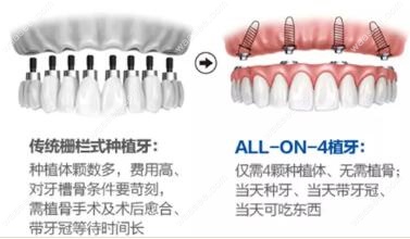 全口allon6即刻负重种植牙的价格比allon4贵,那么两者哪个更好