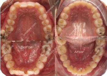 我在好佰年口腔做牙齿矫正前和牙齿矫正后的对比图