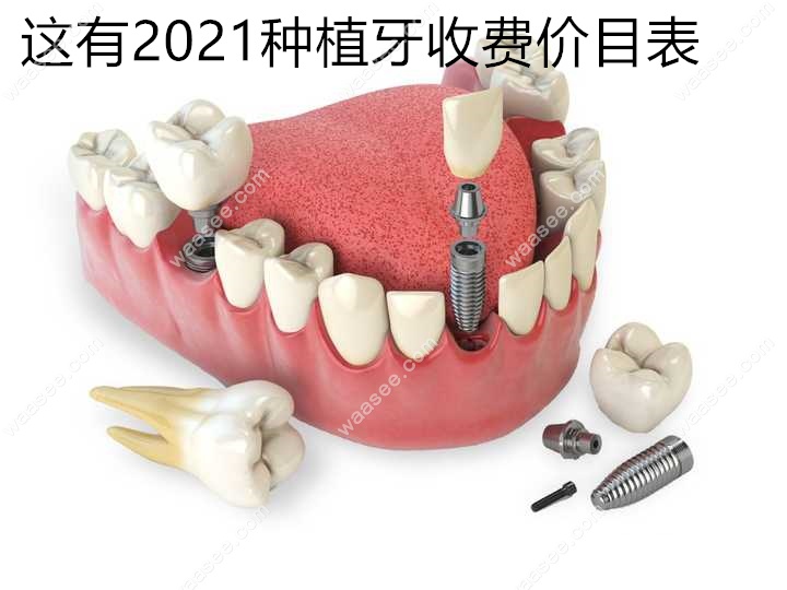 2021种植牙收费价目表