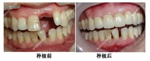 种植牙前后对比照