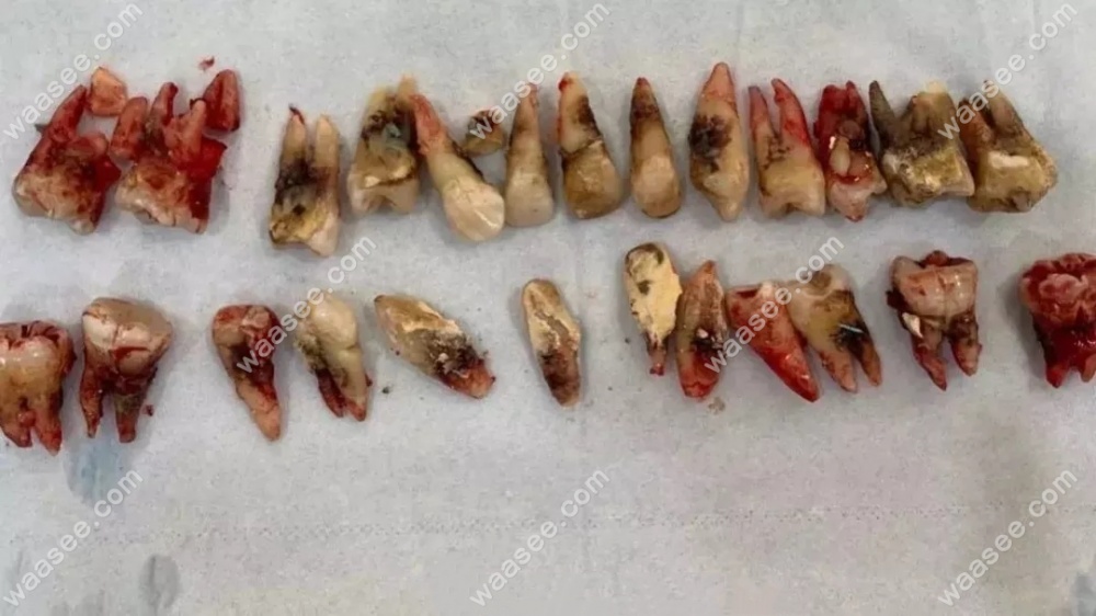 牙周炎全口牙缺失