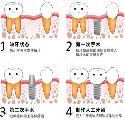 进口种植牙过程图
