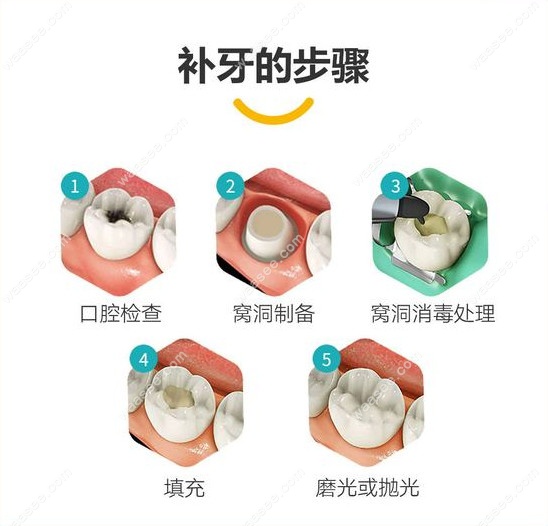 长沙口腔医院做树脂补牙的过程