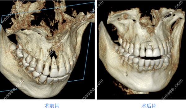 门牙根尖囊肿切除术前和术后效果图
