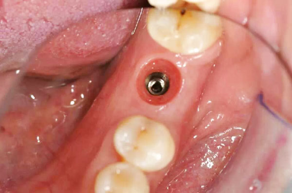 左侧下颌第一磨牙缺失两年后做种植牙修复的案例效果