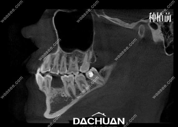牙齿缺失种植前拍的CT照片