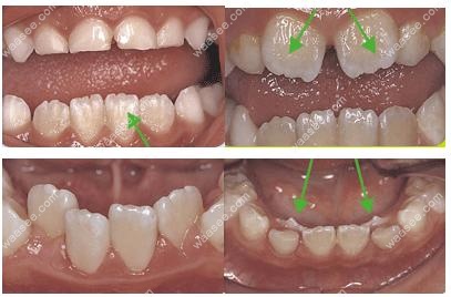 儿童牙齿畸形问题：牙齿拥挤、牙齿稀疏、双排牙、地包天等.jpg