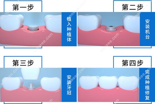 种植牙过程步骤图示