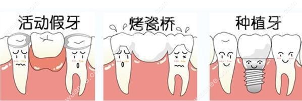 活动假牙和种植牙区别