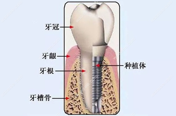 种植体在牙槽骨中的示意图