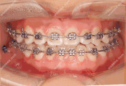 金属托槽矫正牙齿中线不齐.jpg