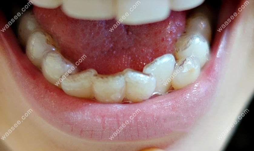 牙齿矫正前的图片