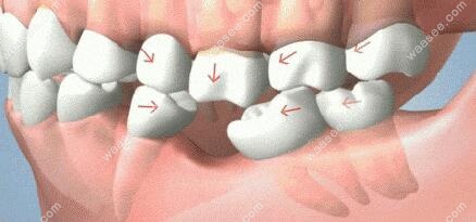 牙齿缺失 两边邻牙倾倒