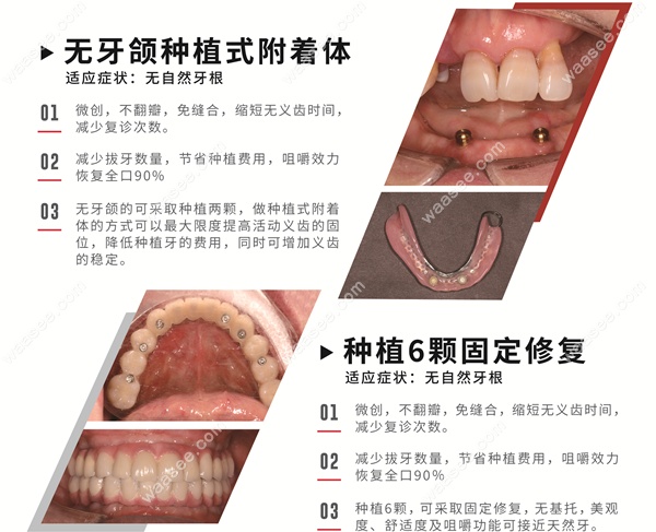 牙颌种植式附着体修复