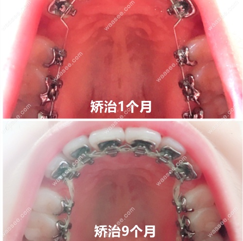 舌侧矫正1个月和9个月的效果图