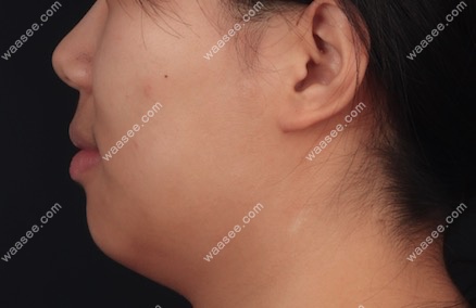 西安鼎秀齿科矫正前后对比图.png