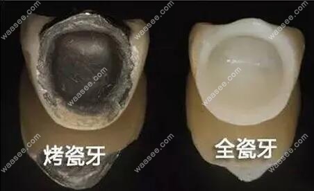 烤瓷牙和全瓷牙区别图