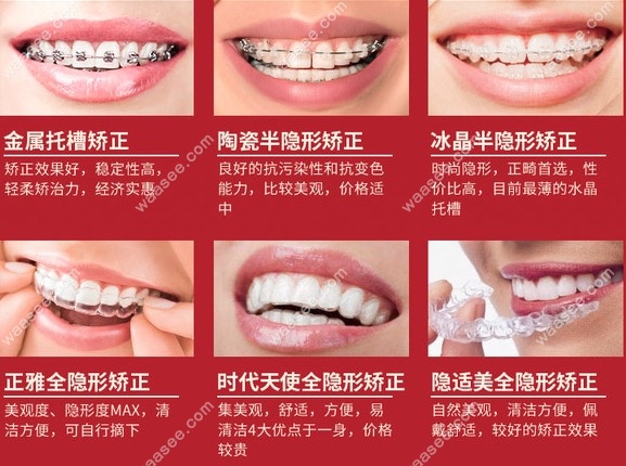 牙齿矫正的方式有哪些.jpg