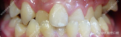 优益佳口腔牙齿矫正前后对比图.jpg